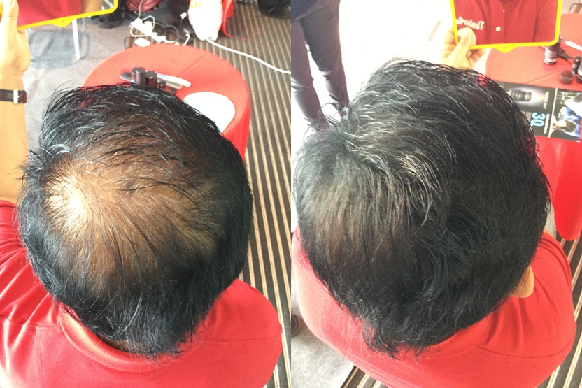 petua rambut gugur dengan toppik